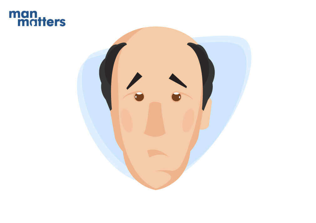 Alopecia naturally androgenetic reverse Treating the